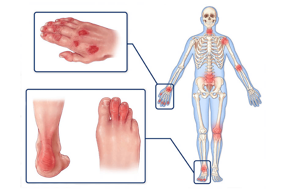 Arthrite psoriasique
