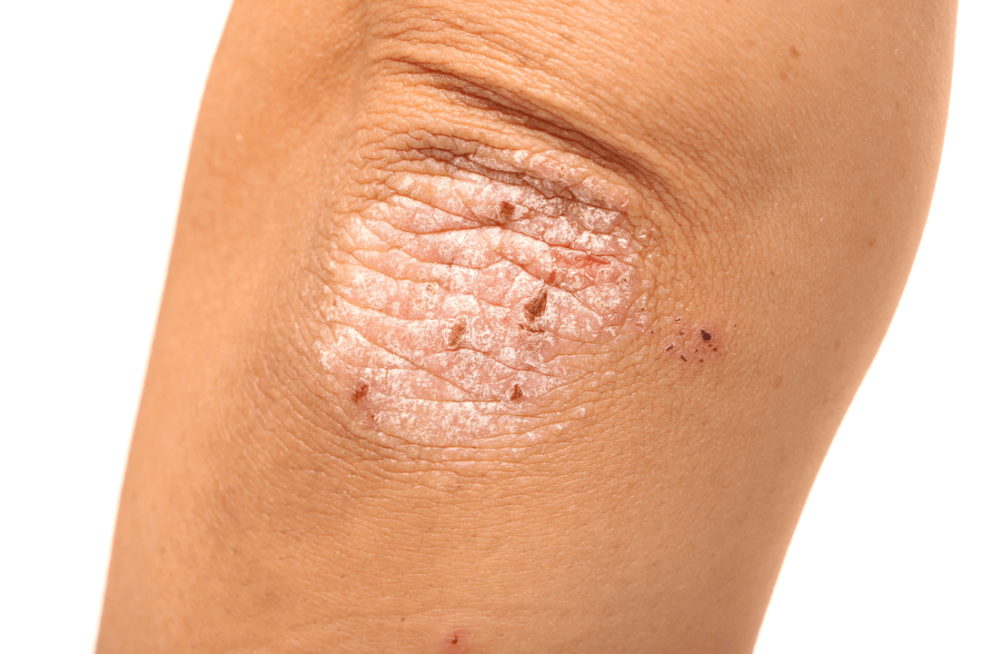 Psoriasis sur la peau