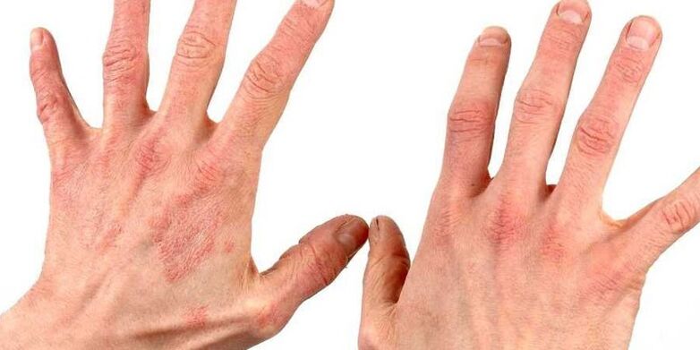 Psoriasis sur les mains, comment traiter les remèdes populaires