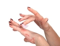 psoriasis sur les mains