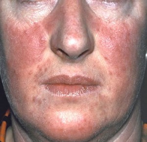 comment traiter le psoriasis sur le visage