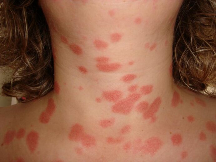 Plaques de psoriasis sur la peau