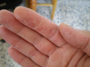 psoriasis sur les mains
