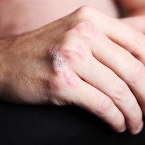 Plaque de psoriasis sur le bras