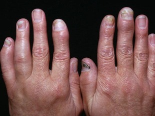 le psoriasis de l'arthrite