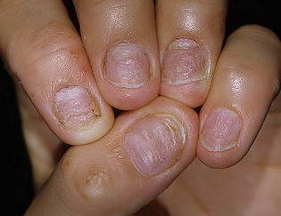 le psoriasis des ongles